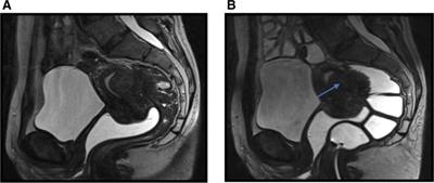 The Role of Magnetic Resonance Imaging in the Planning of Surgical Treatment of Deep Pelvic Endometriosis